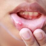 Cómo quitar una postemilla bucal - Remedios caseros y consejos